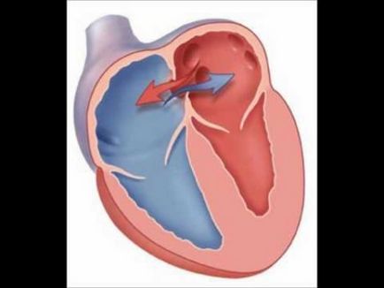 Nyitott foramen ovale, a szívében egy gyermek a csecsemőknél és újszülött lyuk, a szív