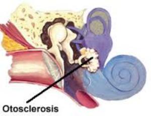 Otosclerosis tünetek és a kezelés a fül