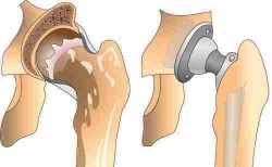 Vélemények a betegek körülbelül csípőprotézis