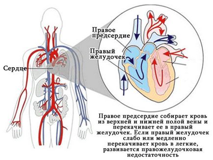 A jobb kamrai szívelégtelenség - okok, tünetek, panaszok kezelésére, elsősegély