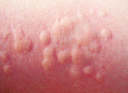 Az okok az allergia - előfordulása a felnőtteknél, csalánkiütés, a nyak, a tenyér, a bőr az arcon