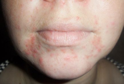 Az okok az allergia - előfordulása a felnőtteknél, csalánkiütés, a nyak, a tenyér, a bőr az arcon