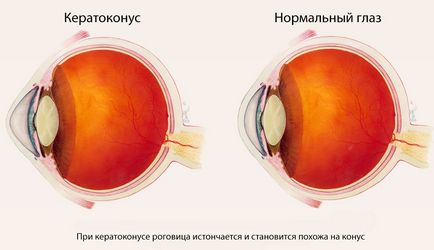 Az okok a rövidlátás (myopia) gyermekeknél és felnőtteknél