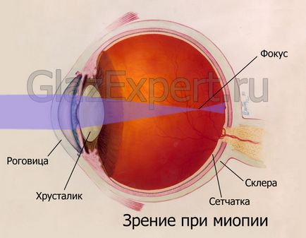 Az okok a rövidlátás (myopia) gyermekeknél és felnőtteknél