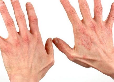 Egyszerű dermatitis - klinikai kép, kezelés, terápia (kezelés) Egyszerű dermatitis - klinikai kép, kezelés, terápia