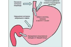Hányás ivás után mi a teendő (típusai hányás étkezés után) Hányás ivás után, mit kell tenni