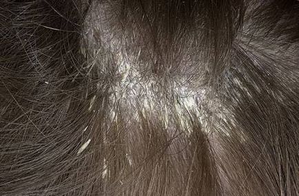 Peeling fejbőr miért erősen kifejtve a gyerek, mit kell tenni