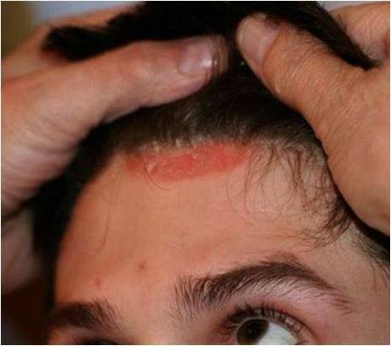 Peeling fejbőr miért erősen kifejtve a gyerek, mit kell tenni