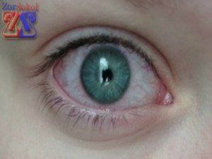 Szindróma - vörös szem - a fő okai és kezelése