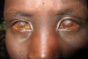 trachoma szem