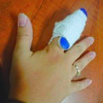 Contusio az ujját a kéz tünetek, okok, kezelés, fotók