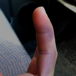 Contusio az ujját a kéz tünetek, okok, kezelés, fotók