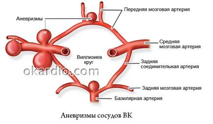 Variant a kör Willis ami azt jelenti, tünetek és diagnózis