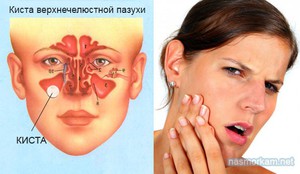 Maxillaris ciszta a jobb és a bal arcüreg melléküregek