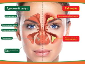 Maxillaris ciszta a jobb és a bal arcüreg melléküregek