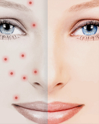 Típusú pattanások az arcon és a test, akne különböző fotó