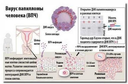 A humán papillomavírus, az oka, hogy hogyan fertőzés tünetei nőknél