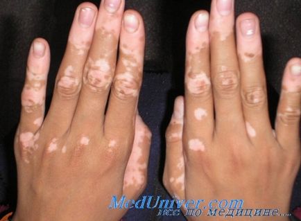 Vitiligo - impresszum aura vagy betegség, amelyből jelennek meg a bőrön fehér foltok
