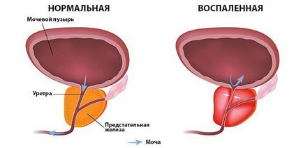 a prosztata gyulladása férfiakban a tüneteket és okait, a kezelés és a fájdalomcsillapítás