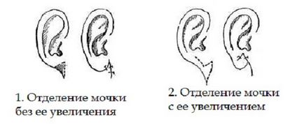Benőtt vagy tapadó fülcimpa - okok, diagnózis és kezelés