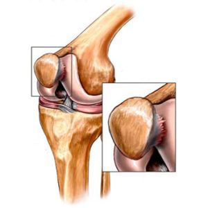 Chondromalacia térdkalács (térdízület) - kezelés fokozat