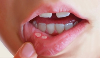 Fekélyek a szájban - kezelés otthon, hogyan lehet megszabadulni