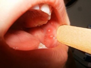 Fekélyek a szájban okok és a kezelés otthon