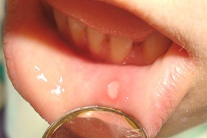 Fekélyek a szájban okok és a kezelés otthon