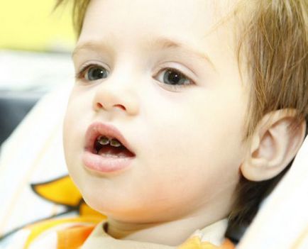 Miért silvers fogak gyermekek archaikus tejtermékek generációs módszer védelem