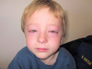 Алергични заболявания, сортове и третиране