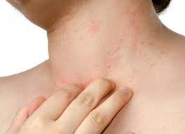 Алергия към чесън и може да има каквито и да било симптоми при възрастни