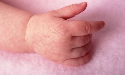 Алергия при дете на ръце и нейното лечение