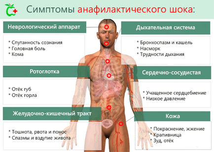 Анафилактичен шок симптоми, причини, лечение, прогноза, диагностика