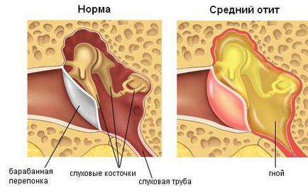 Болести на ухото на възрастни симптоми и лечение, болестта на ухото