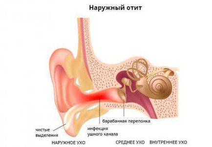 Болести на ухото на възрастни симптоми и лечение, болестта на ухото