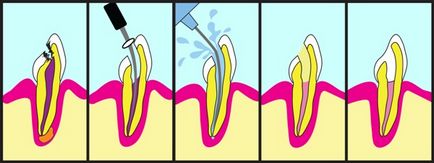 Зъбобол след пълнене причини и лечение