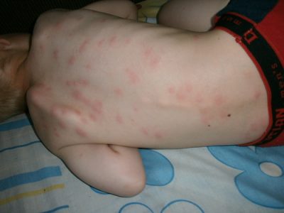 Най-опасни алергии при децата