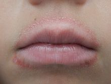 Сърбеж устните причини и как да се справят с болестта