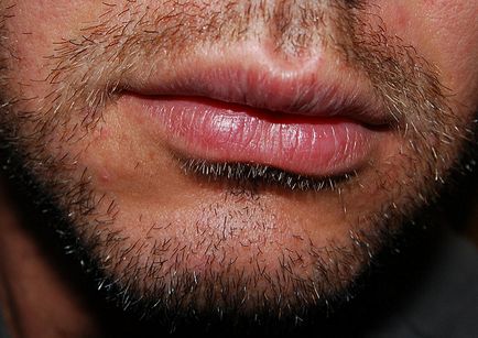 Сърбеж устните причини и как да се справят с болестта