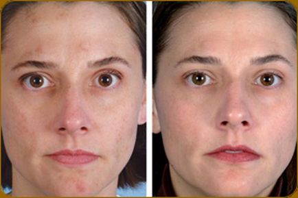 Ултразвуково почистване лице (Ултразвуков пилинг на лицето) - Какво е това, ревюта, противопоказания,