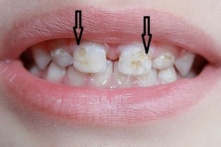 Това, което се зъби се рушат в дете и възрастен начини за справяне с причините и последствията
