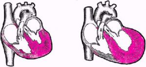 Какво е инфаркт ремоделиране