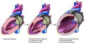 Какво е инфаркт ремоделиране