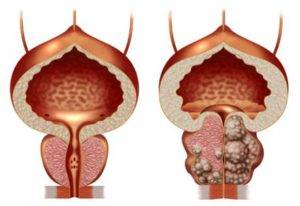 Дифузни промени и дифузно хиперплазия на простатата, който е дифузно промени в