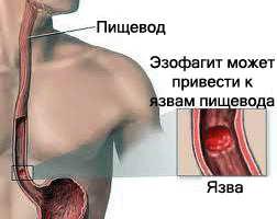 Отдалечени симптоми и лечение езофагит