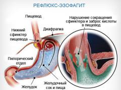 Отдалечени симптоми и лечение езофагит