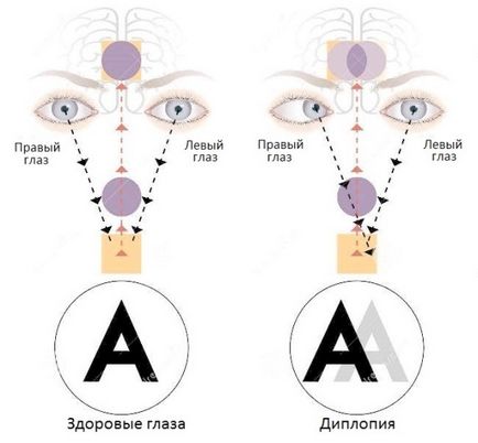 Двойно виждане или двойно виждане за причините, лечение и диагностика
