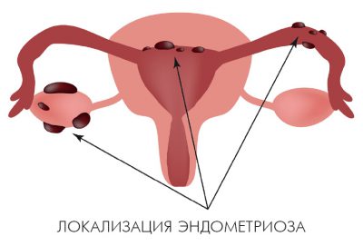 Ендометриозата симптоми и лечение на матката, какво е това и знаци