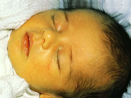 Хемолитична болест на новороденото симптоми и лечение, причини, класификация, клинични форми