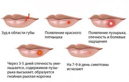 Херпес по устните - причини, признаци, симптоми, лечение